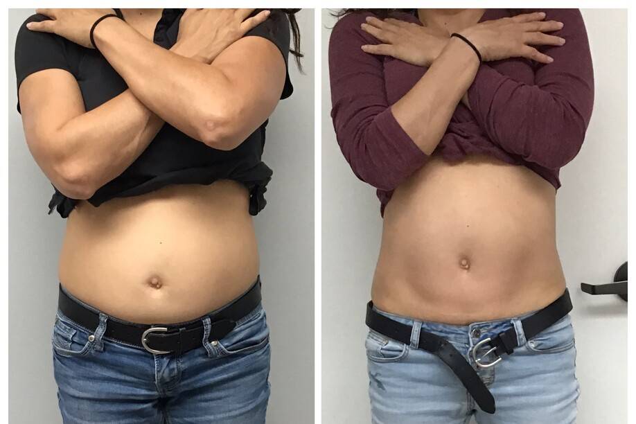California Body Contouring