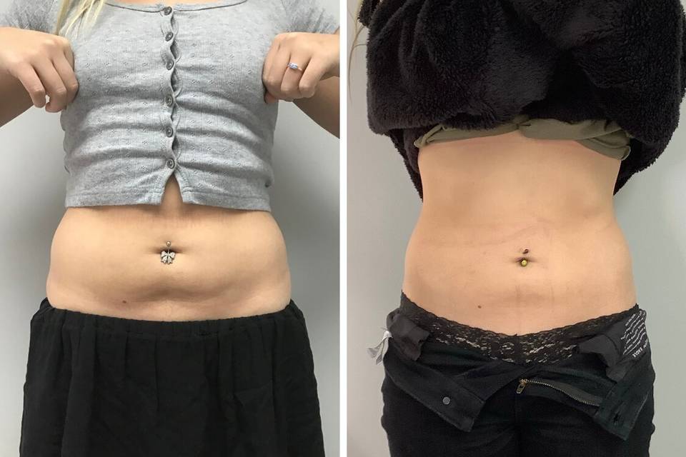 California Body Contouring