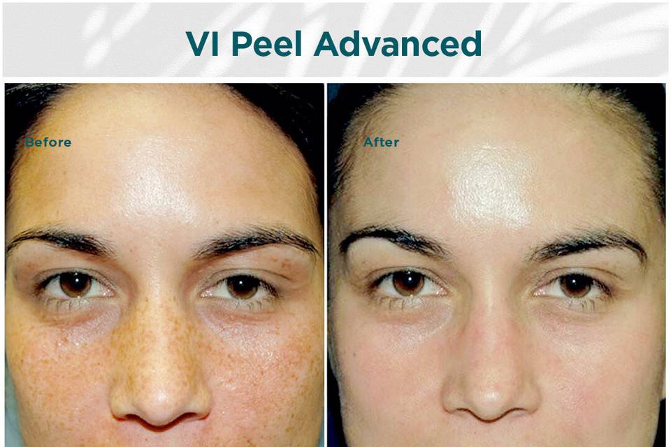 Hyperpigmentation