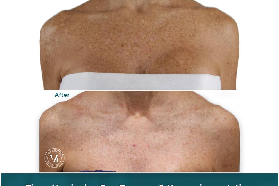 Chest Sun Damage