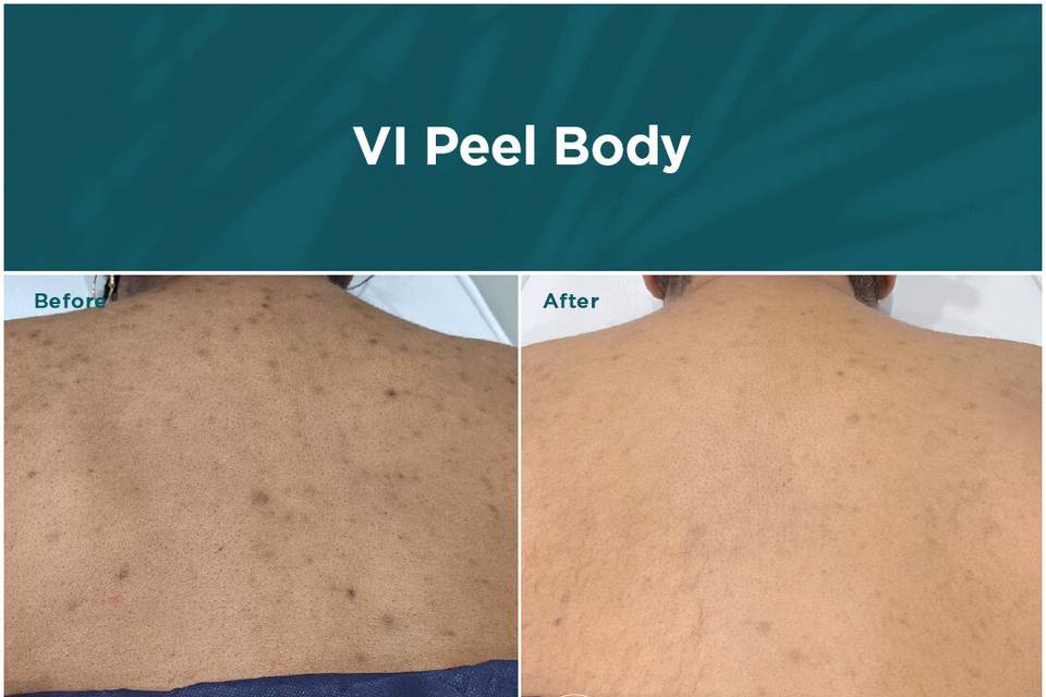 Back acne