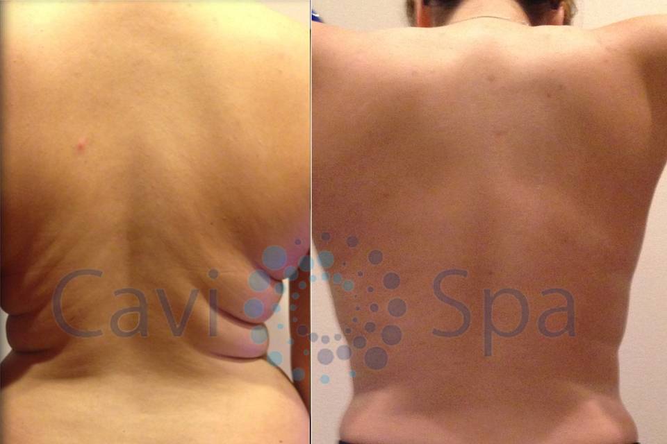 Back Fat GONE!!