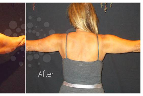 Thinner ARMS!!