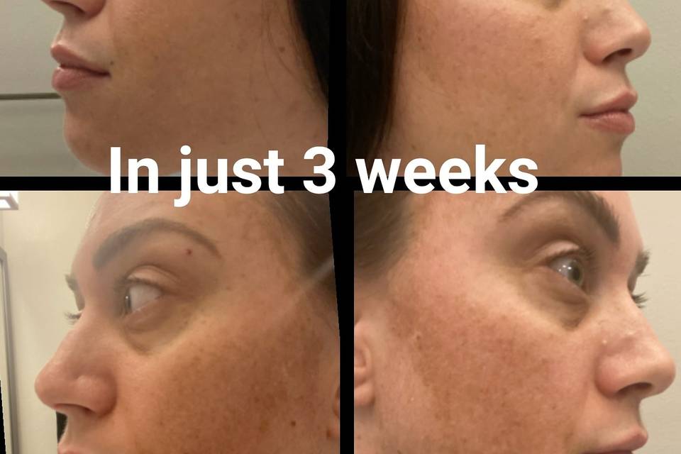 Hyperpigmentation