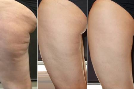 CELLULITE GONE!!