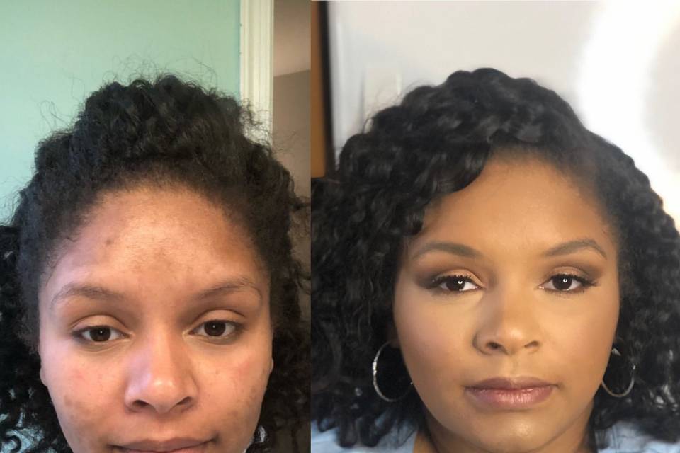 Hyperpigmentation correction