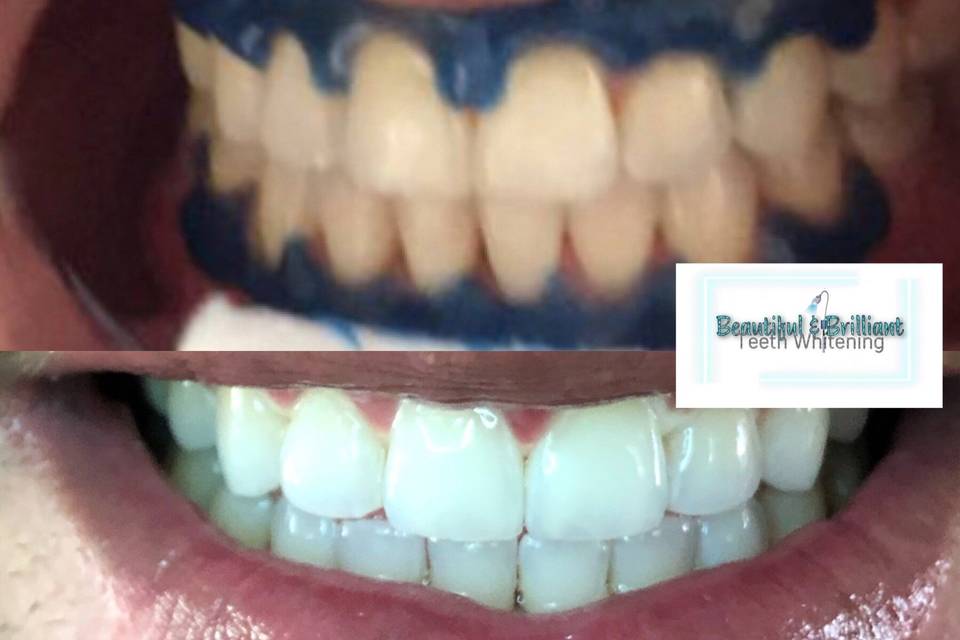 Beautiful & Brilliant Teeth Whitening, LLC. - Beauty & Health - Phoenix ...