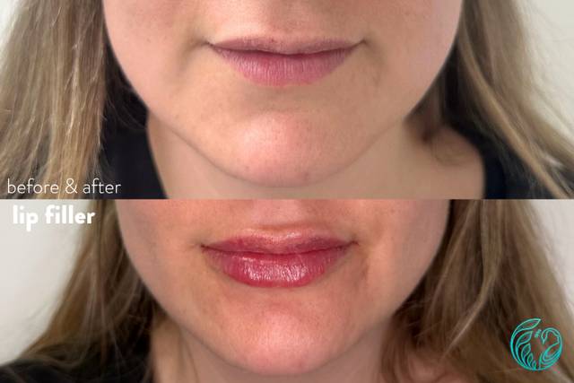 Lip Filler
