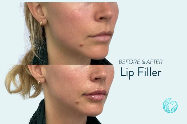 Lip Filler