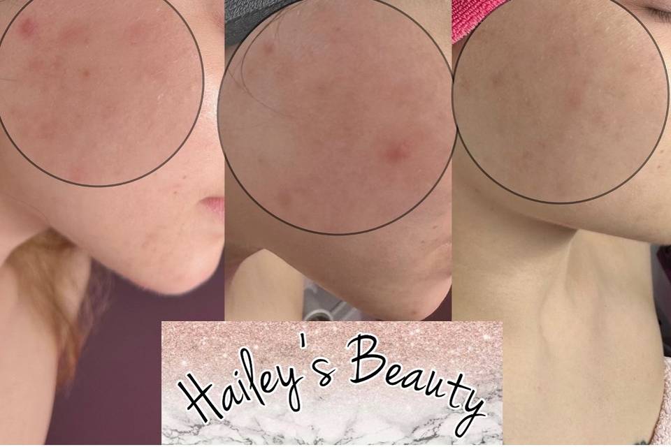 Acne client
