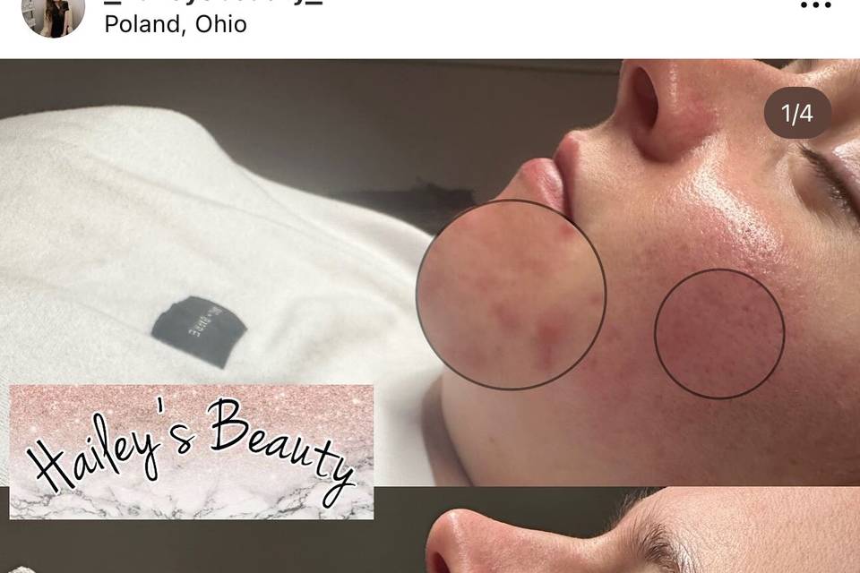 Acne client