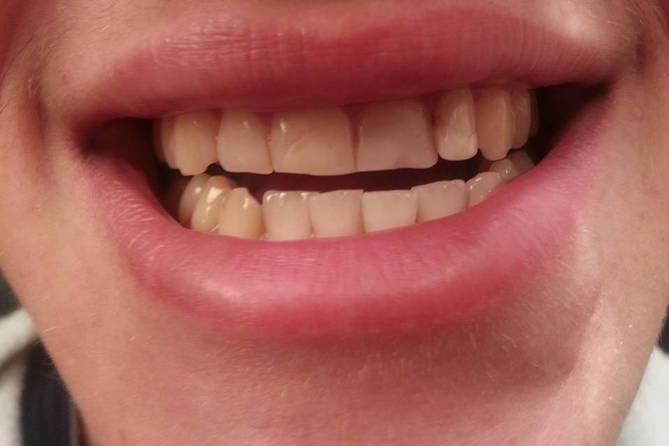 Pearls - Teeth Whitening