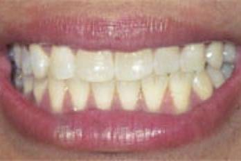 Pearls - Teeth Whitening