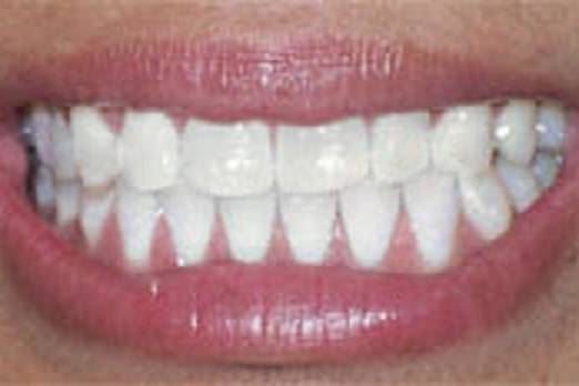 Pearls - Teeth Whitening