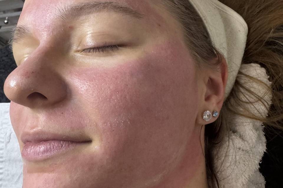 Post Microneedling