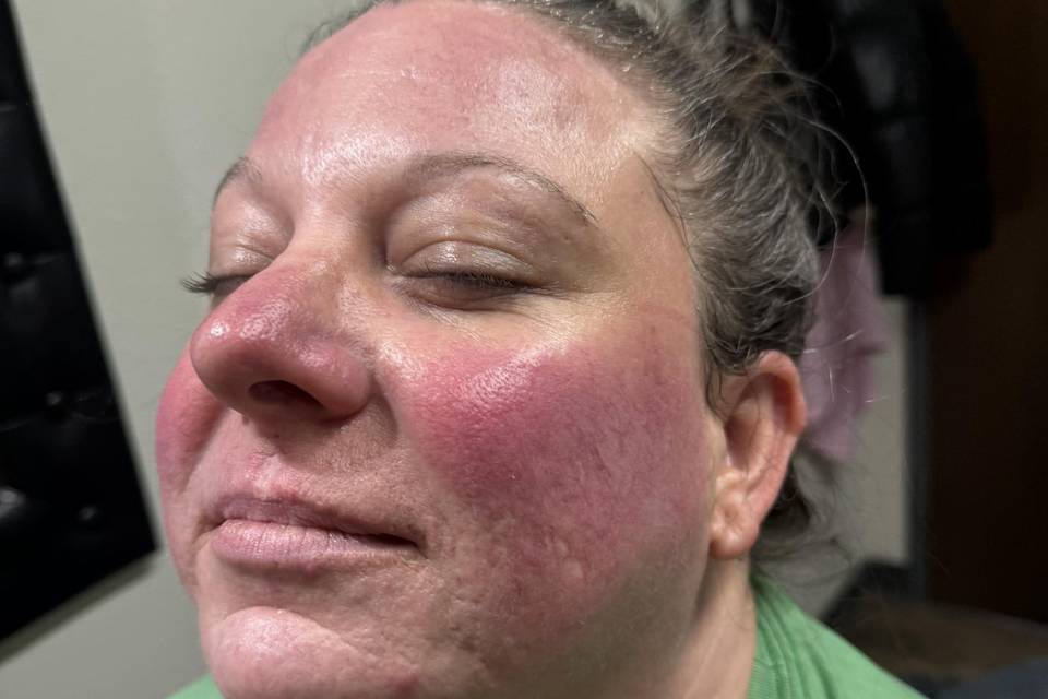 Before severe Rosacea