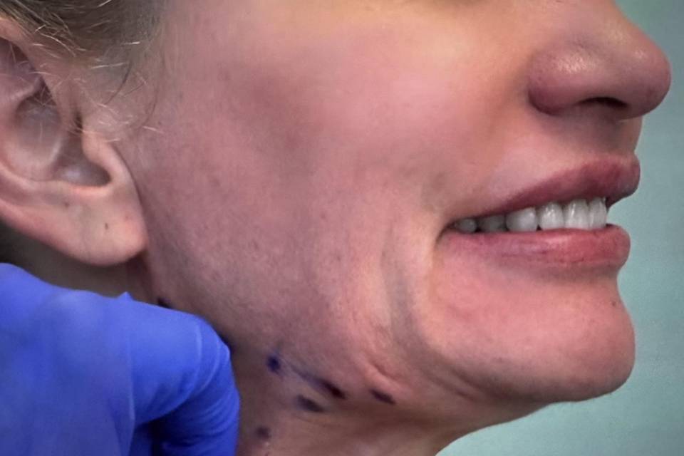 Daxxify jewel face lift