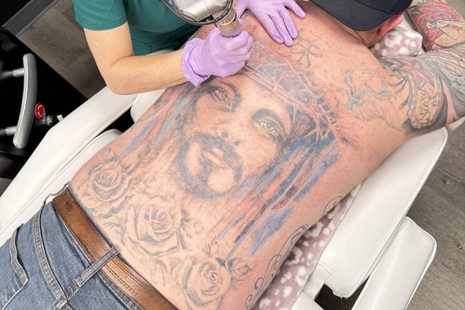 Tattoo removal