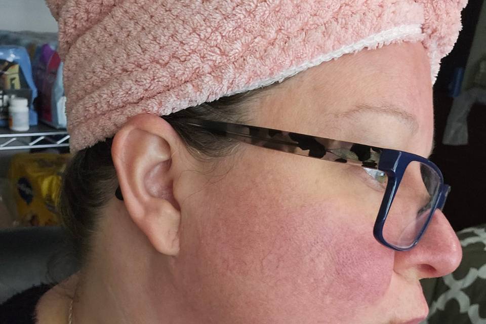 ONLY one day post Rosacea TX