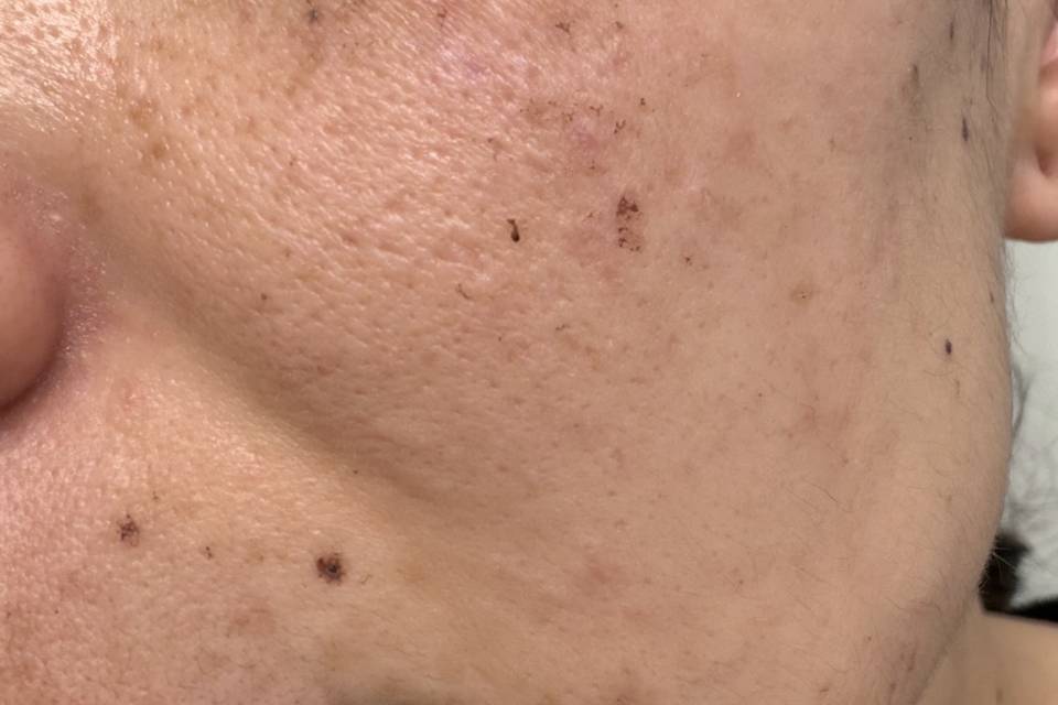 Melasma treated in progress