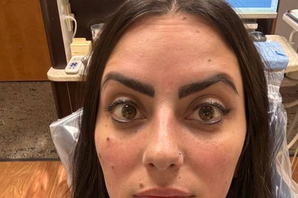 After Xeomin, Surprised Face