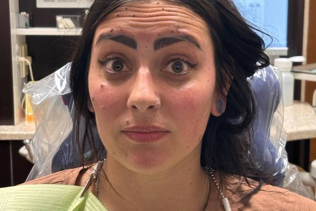 Before Xeomin, Surprised Face