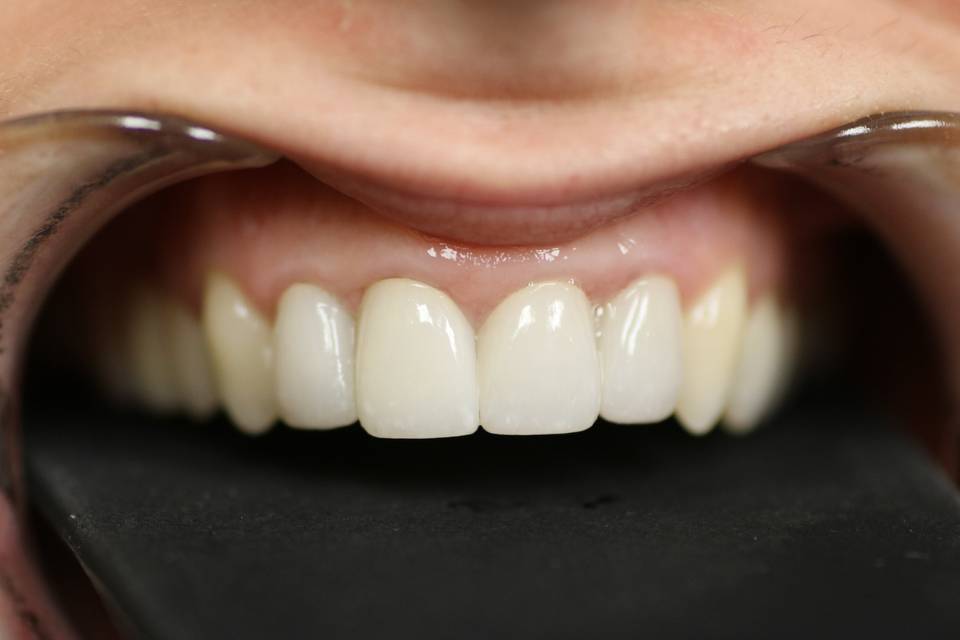 Smile Restoration