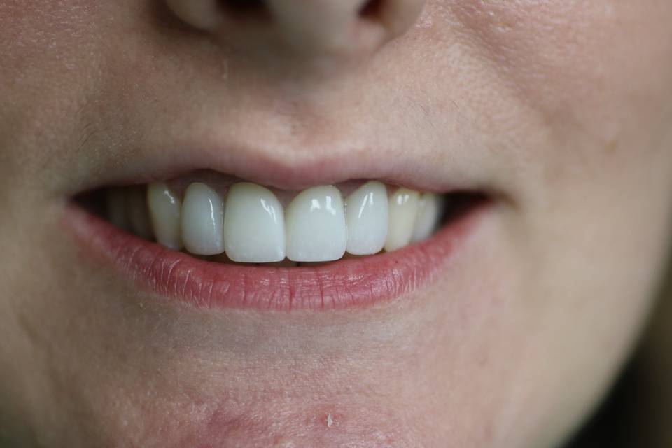 After Photo, 4 Anterior Crowns
