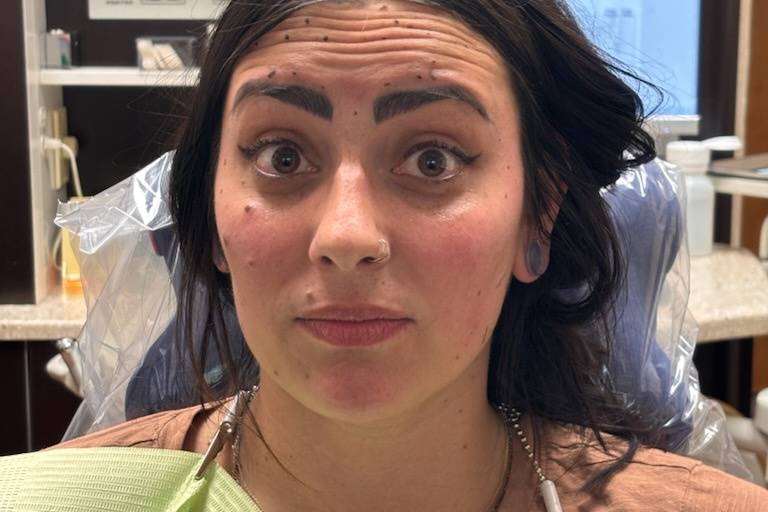 Before Xeomin, Surprised Face