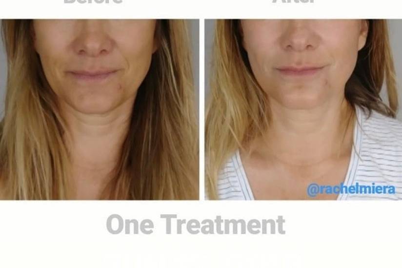 Facial lifting treatment