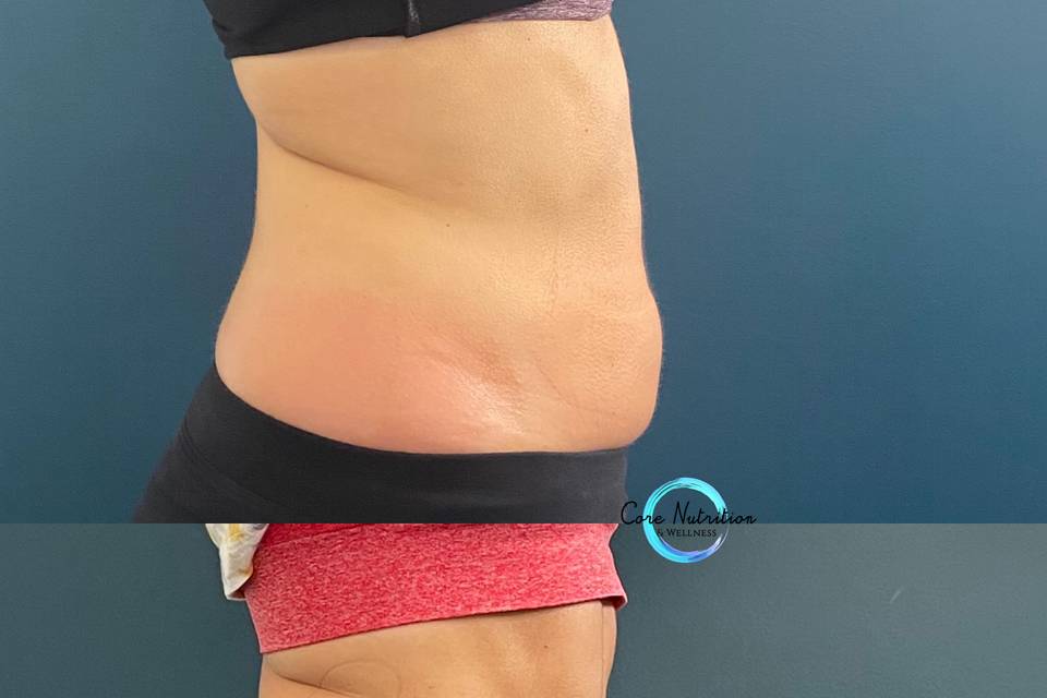 Cryoskin slimming before/after