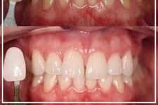 LSB Before and After