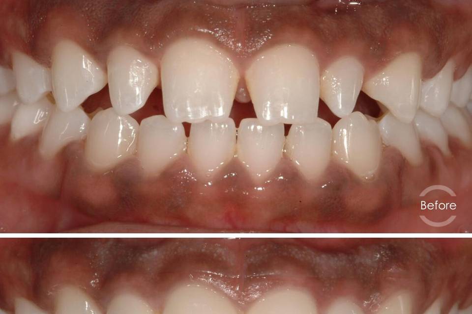 Dental Veneers