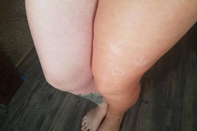 One sprayed leg other is not