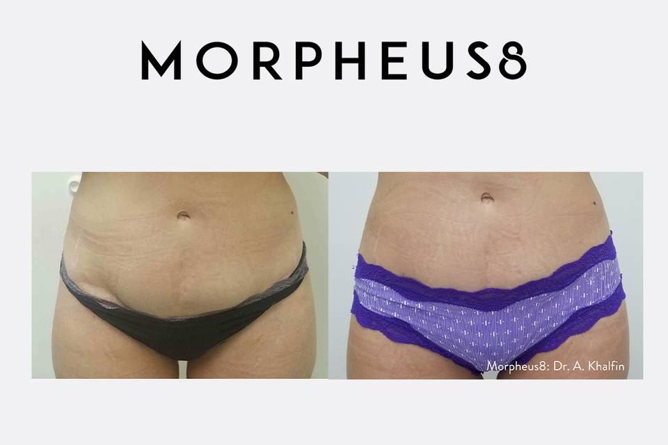 Morpheus8