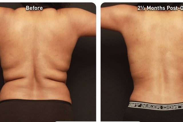 Lipo with J-plasma