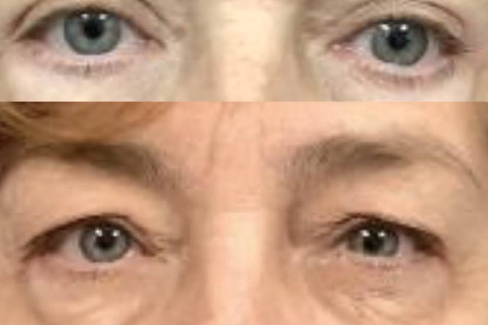 Eye lift