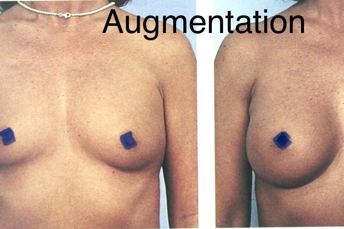 Breast Augmentations