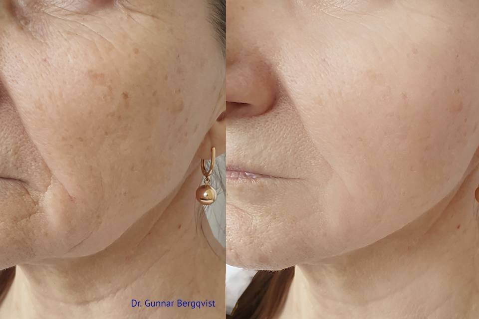 CO2RE skin resurfacing