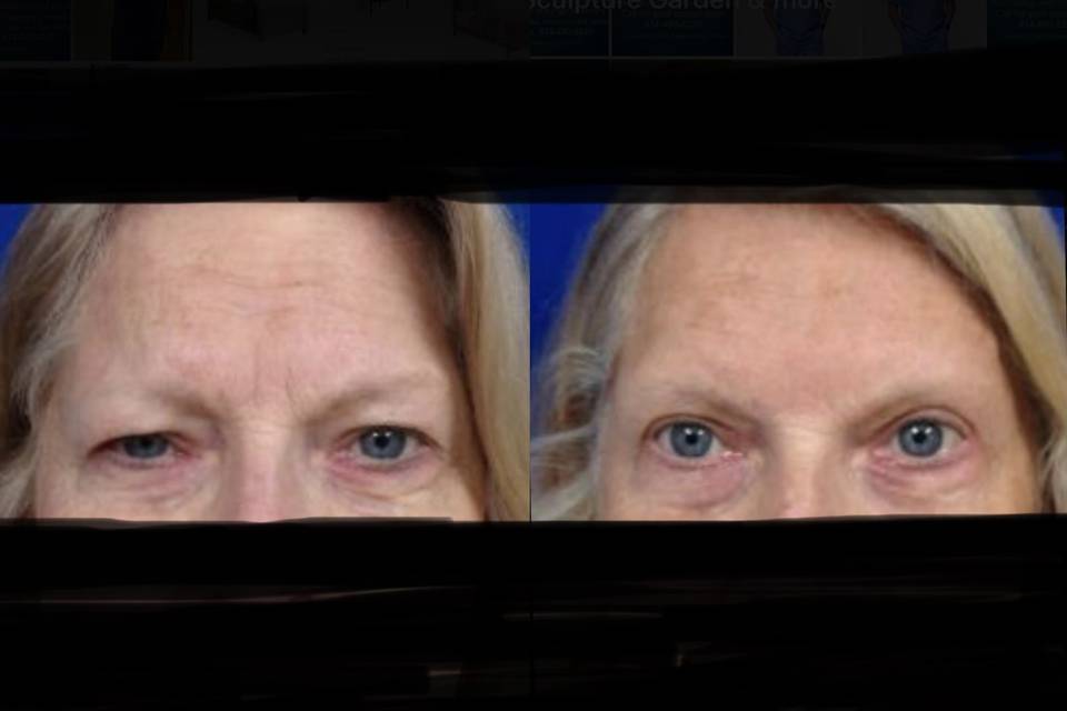 Eye lift