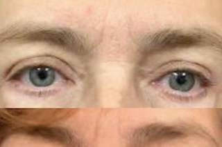 Eye lft