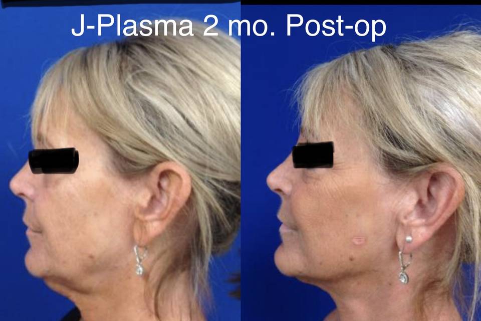 J-Plasma tightening