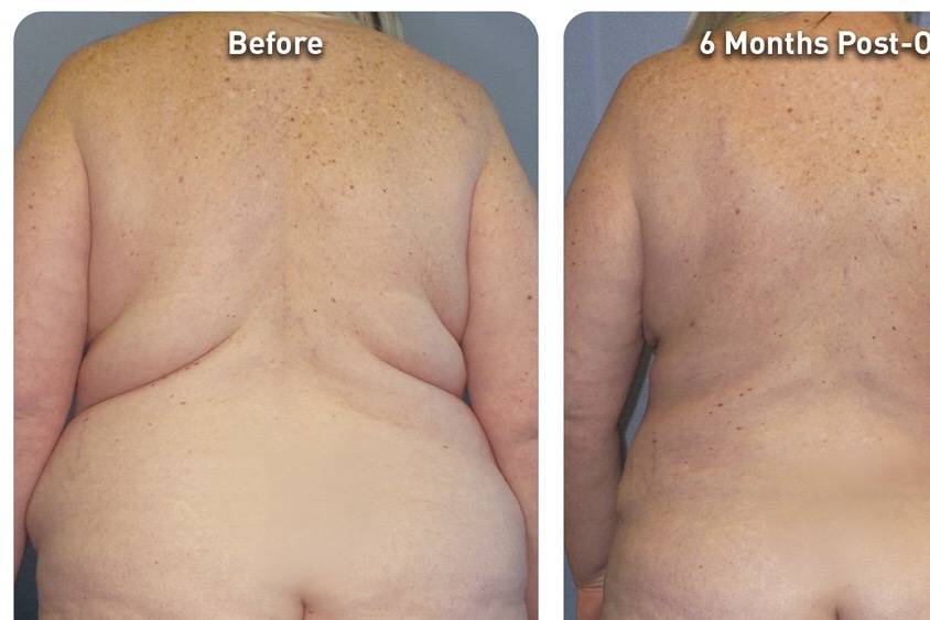 Lipo back