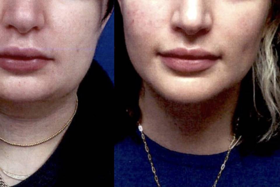 /neckLipo for face