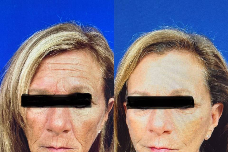 Face/neck lift