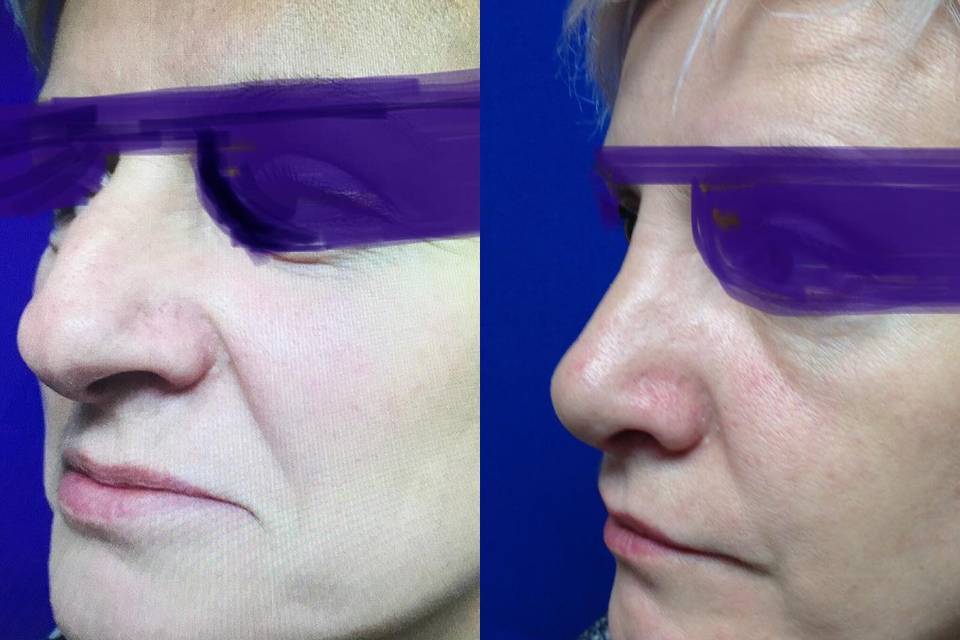 Nose surgery