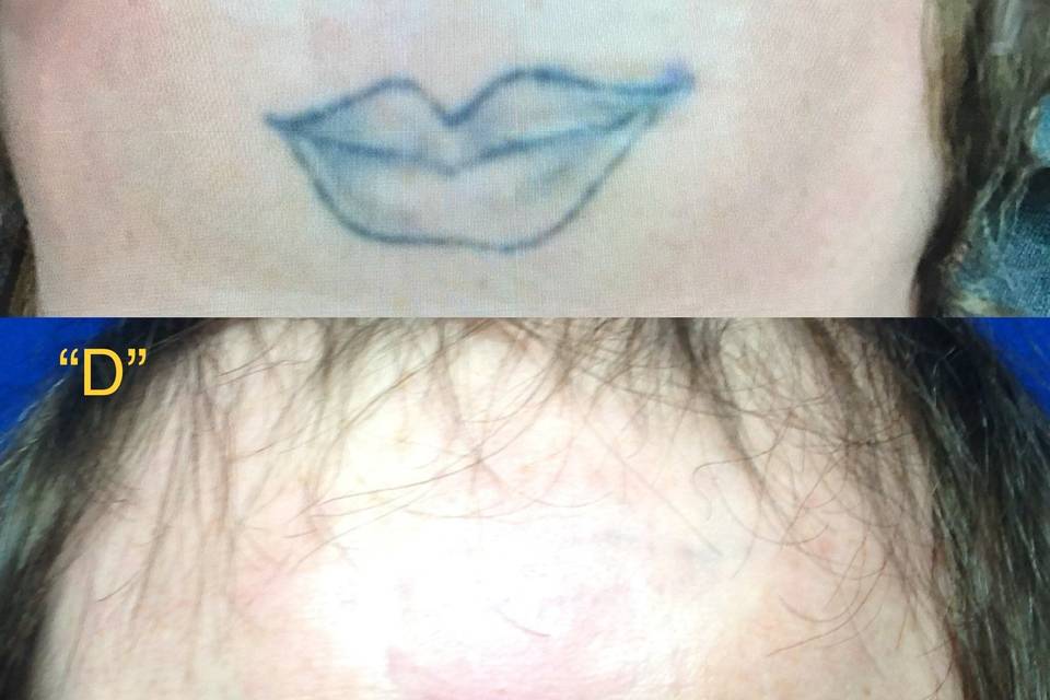Tattoo removal in PA