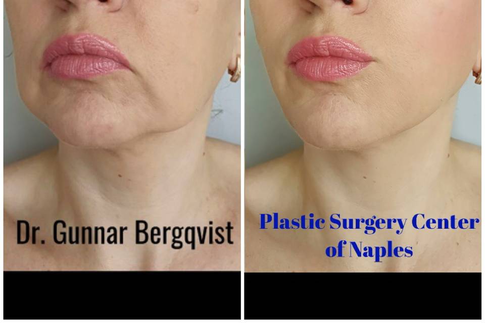 Skin tightening, FDA approved