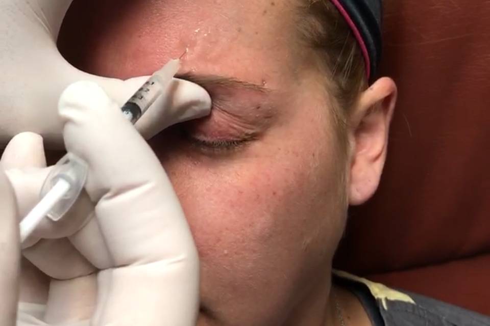 Botox