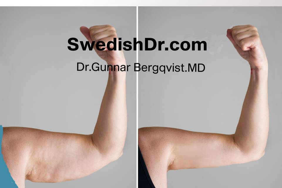 Need pretty arms?